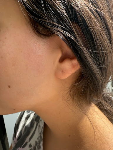 After treatment 2