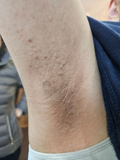 After treatment 4