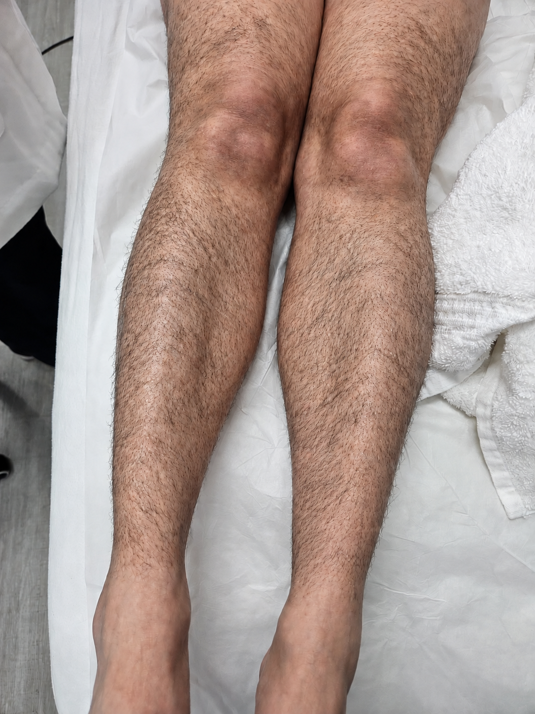 Legs before treatment