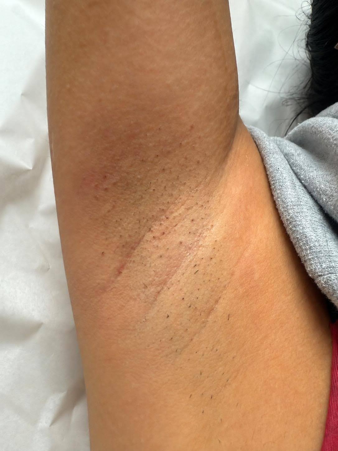 Client underarm after treatment
