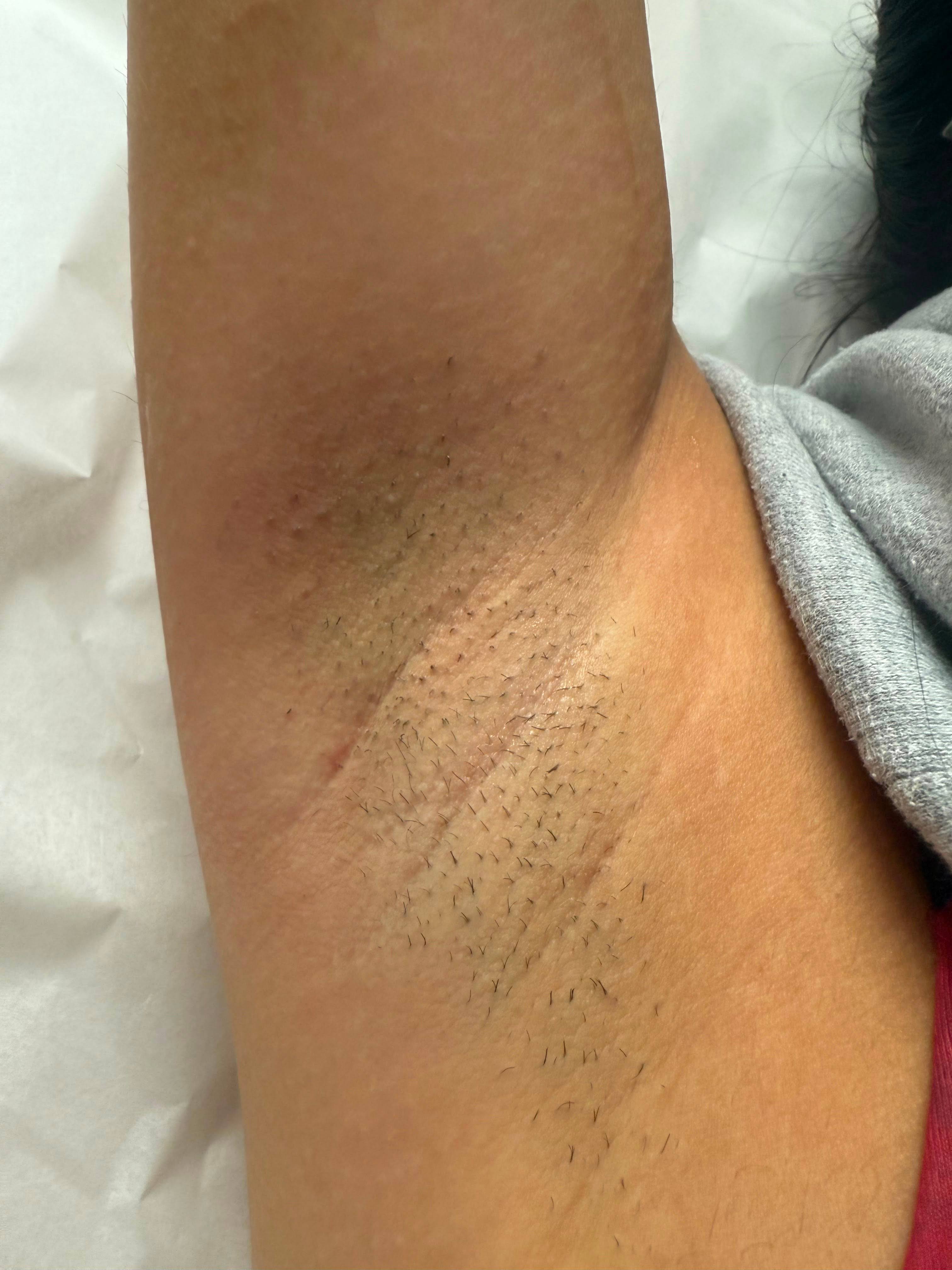 Client underarm before treatment