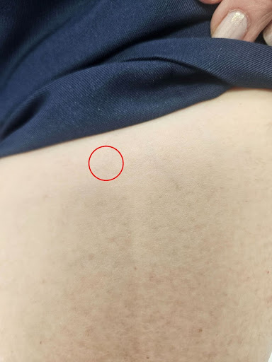 After vein removal