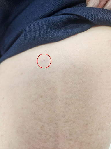 Before vein removal
